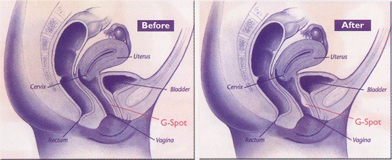 G Spot Amplification HB Health